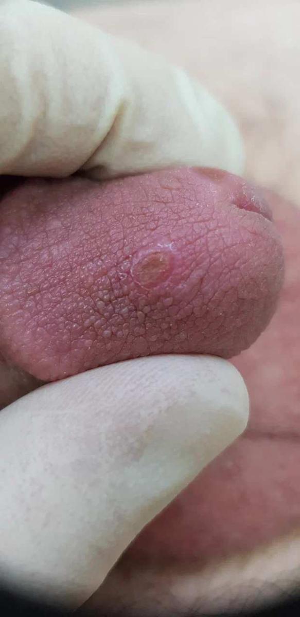 сифилис – опасная ИППП