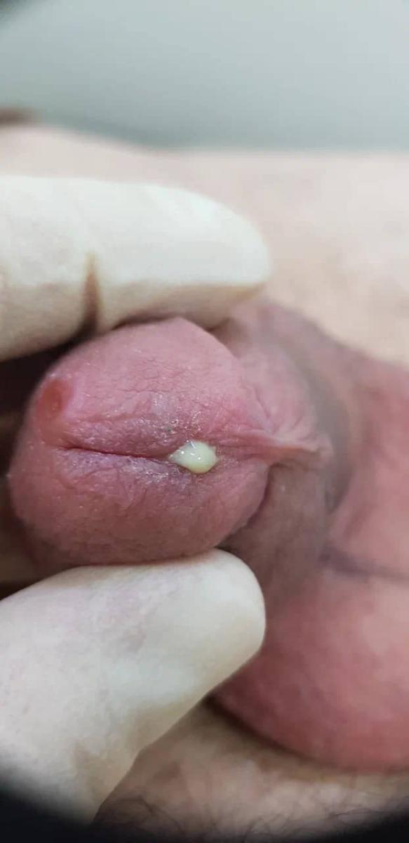 Выделения у мужчин при гонорее 