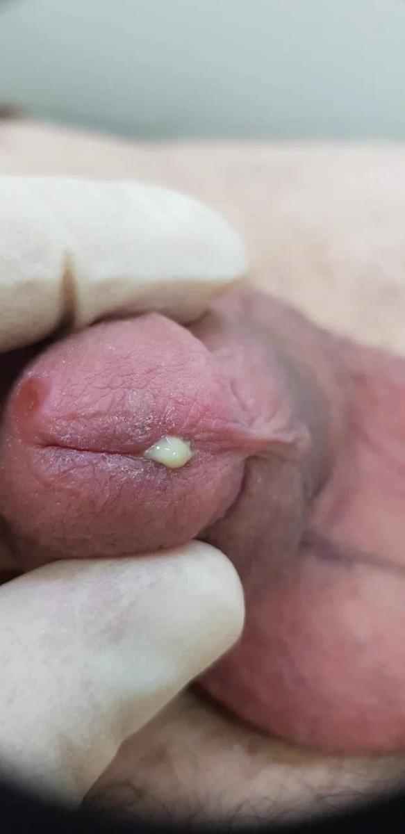 сифилис, гонорея