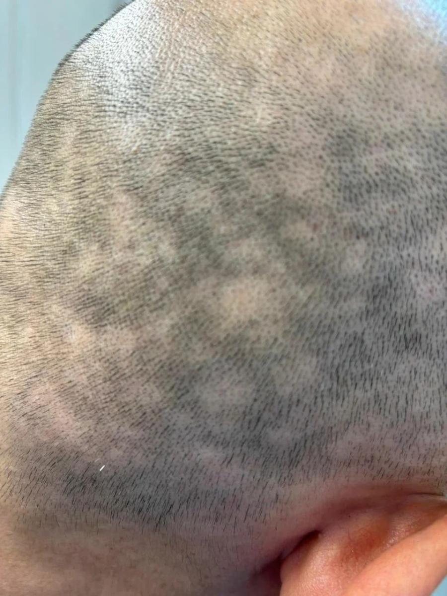 очаговое облысение с выпадением волос на маленьких участках кожи