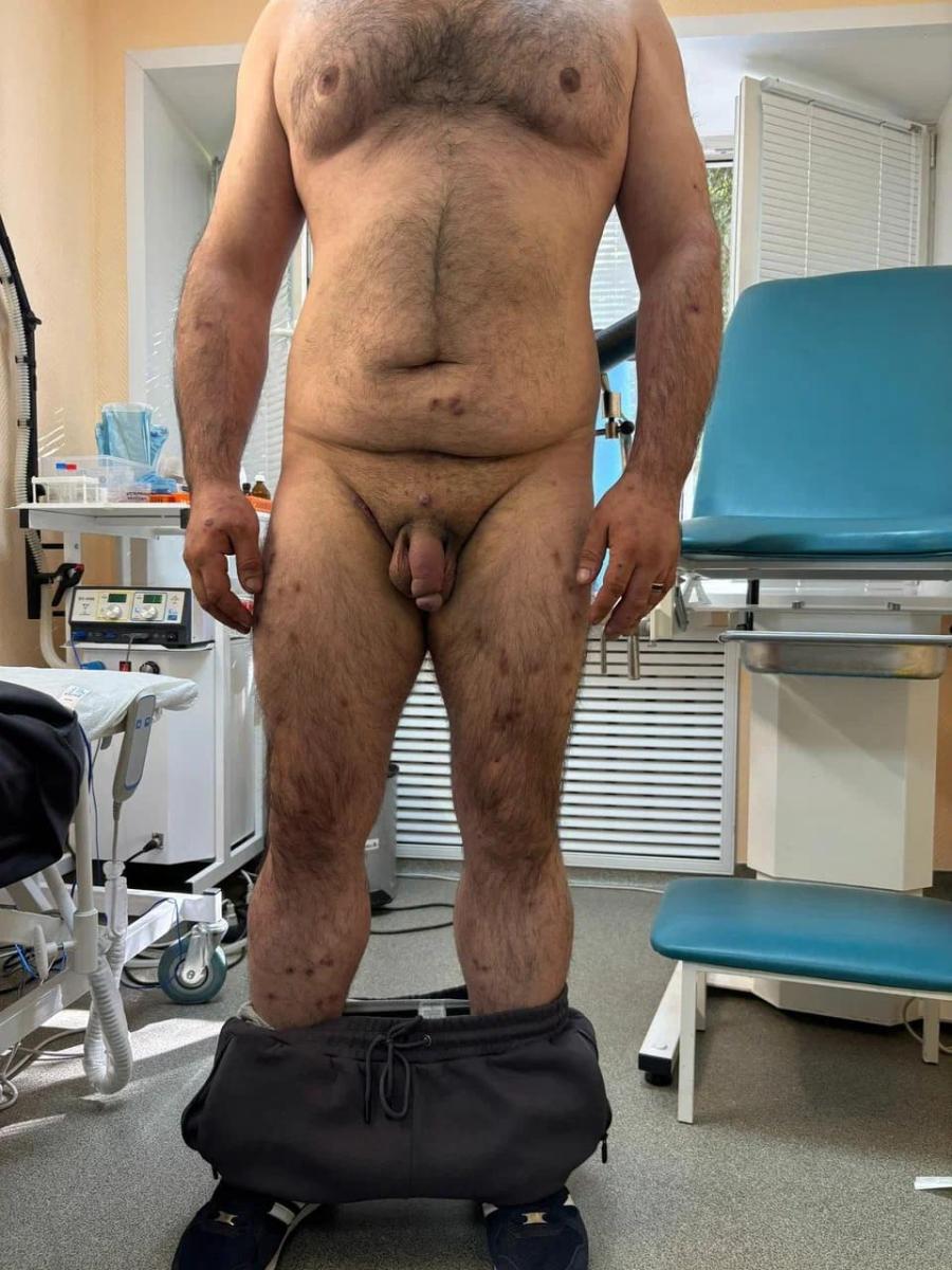 сифилис, гонорея, трихомонада, паронихия сифилис, гонорея, трихомонада, паронихия