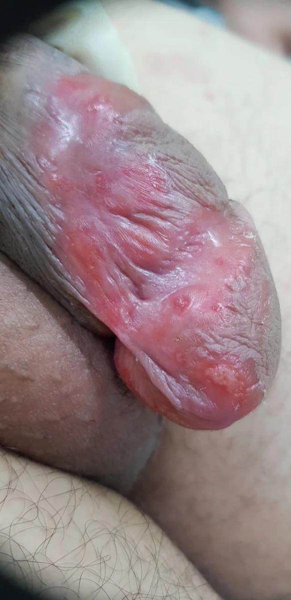 Язвы и эрозии 