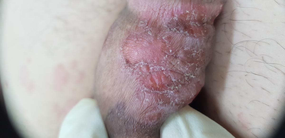 Проявления ИППП каплевидный псориаз