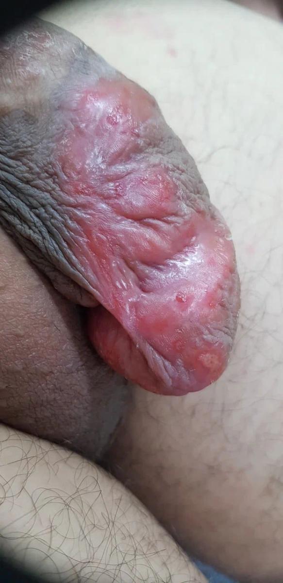 лечении сифилиса