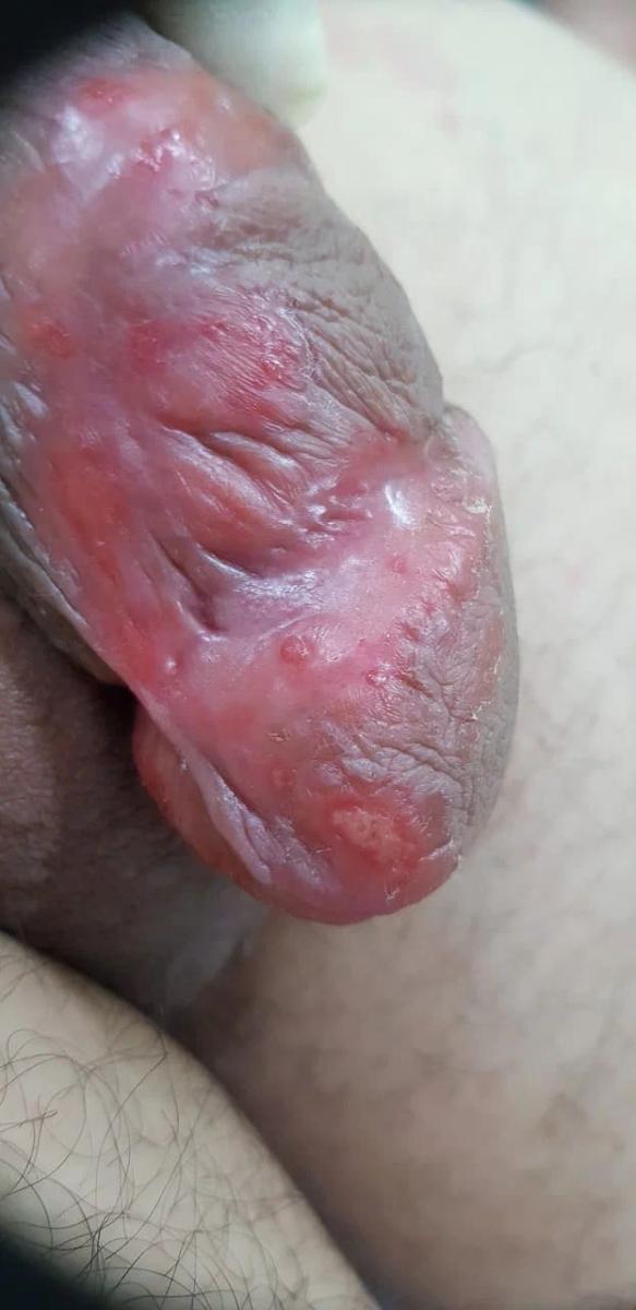 Проявления ИППП каплевидный сифилис