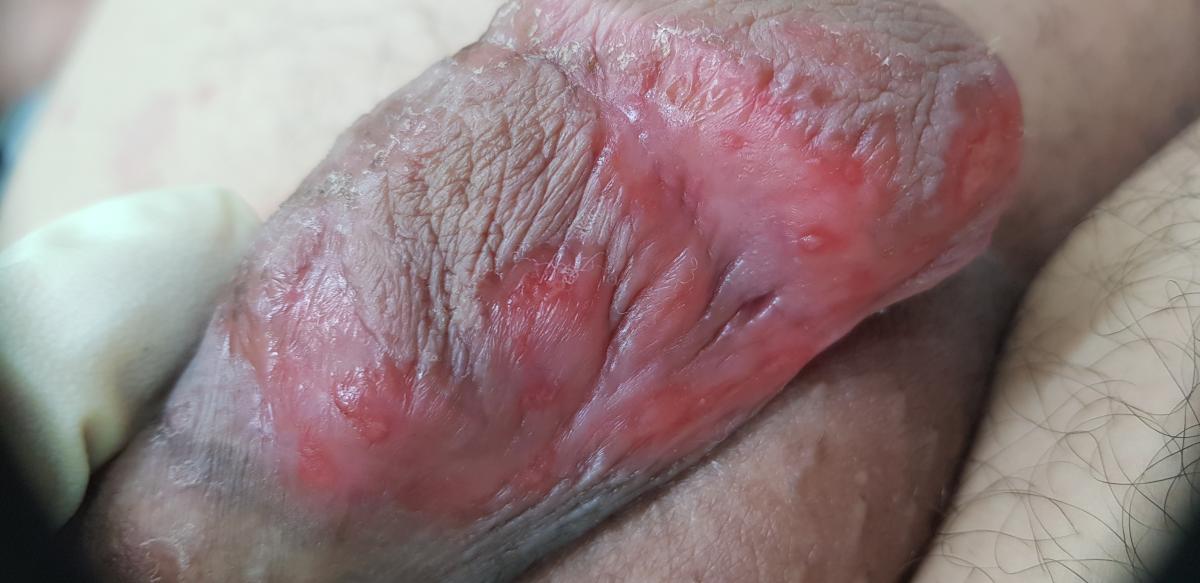 забор крови для контроля эффективности лечения сифилиса