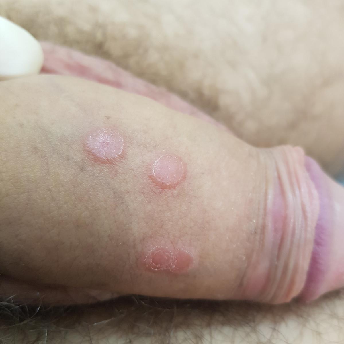 сыпь при сифилисе сыпь при сифилисе