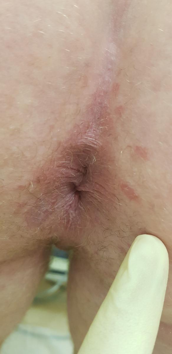  антибиотик пенициллиновой группы