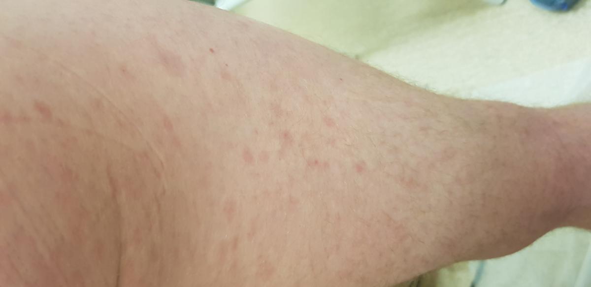 Сыпь - вторичный сифилис Сыпь на теле при вторичном сифилисе