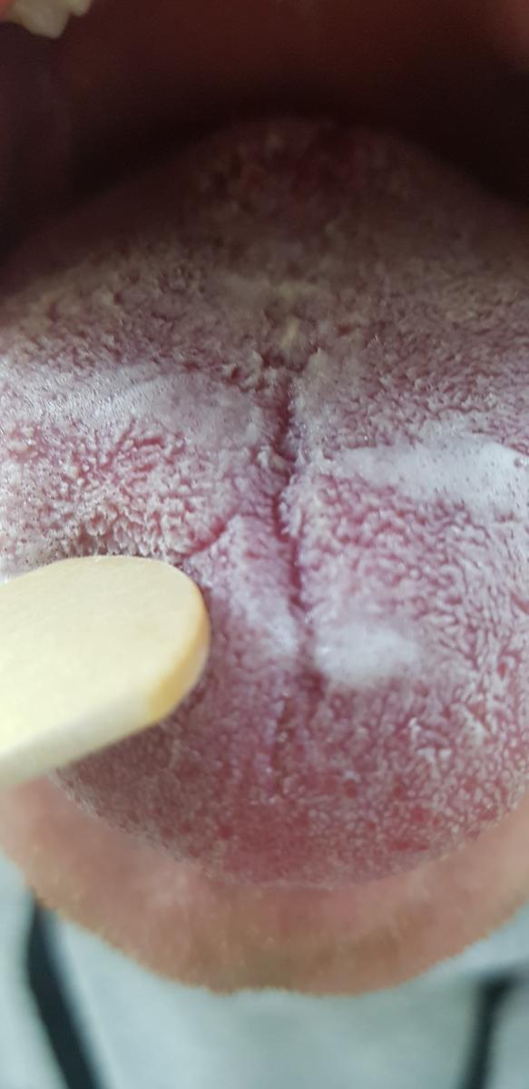 молочница во рту