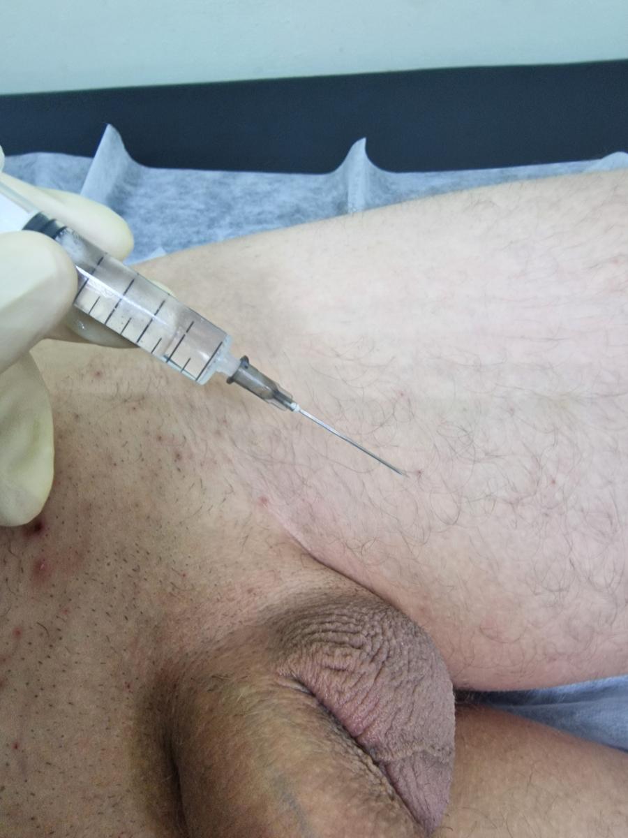 лимфотропное лечение