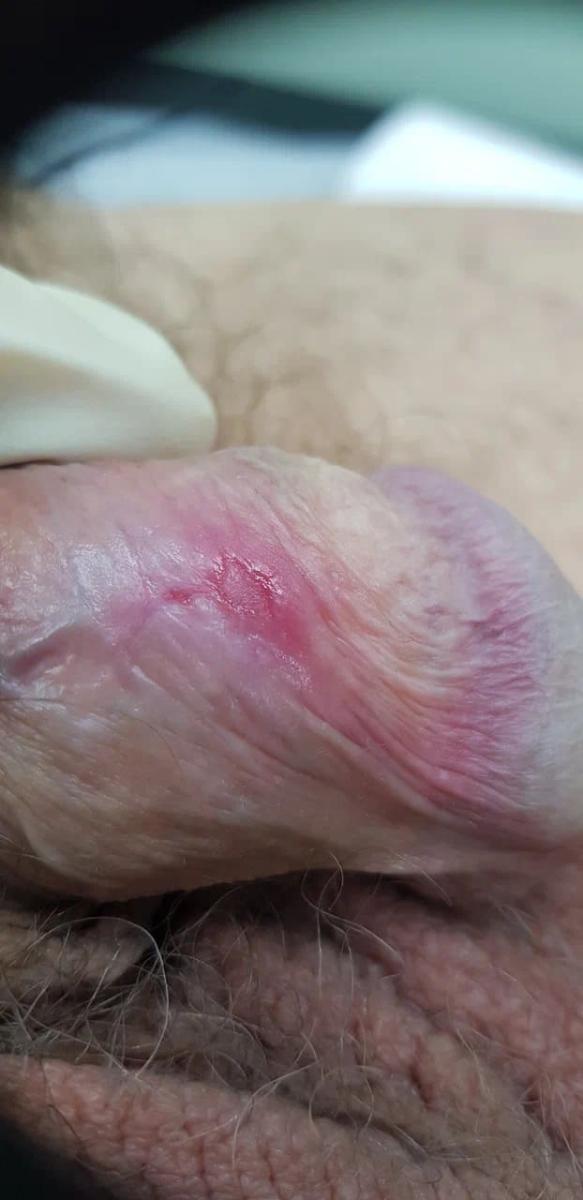 симптомы сифилиса на члене