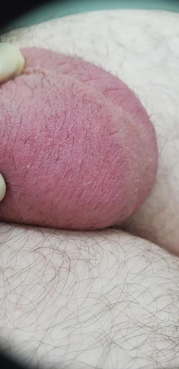 синдром красной мошонки 