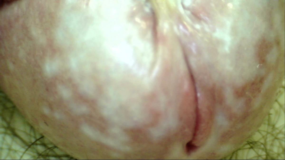 фото склератрофического лихена головки члена