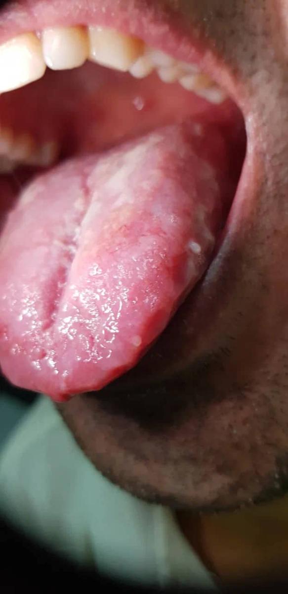слизистая языка слизистая языка
