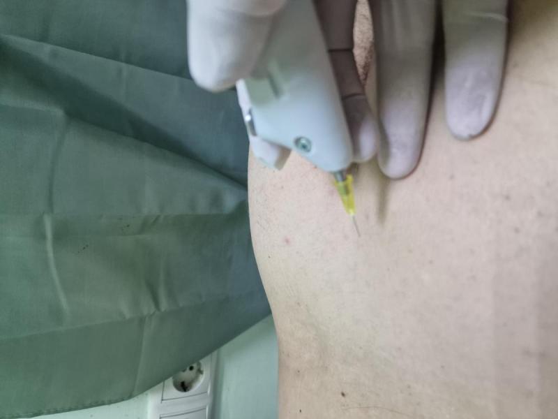 терапия СО2