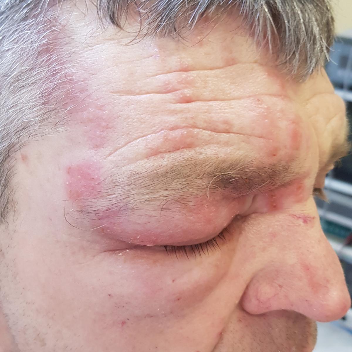 Симптомы на лице Симптомы на лице