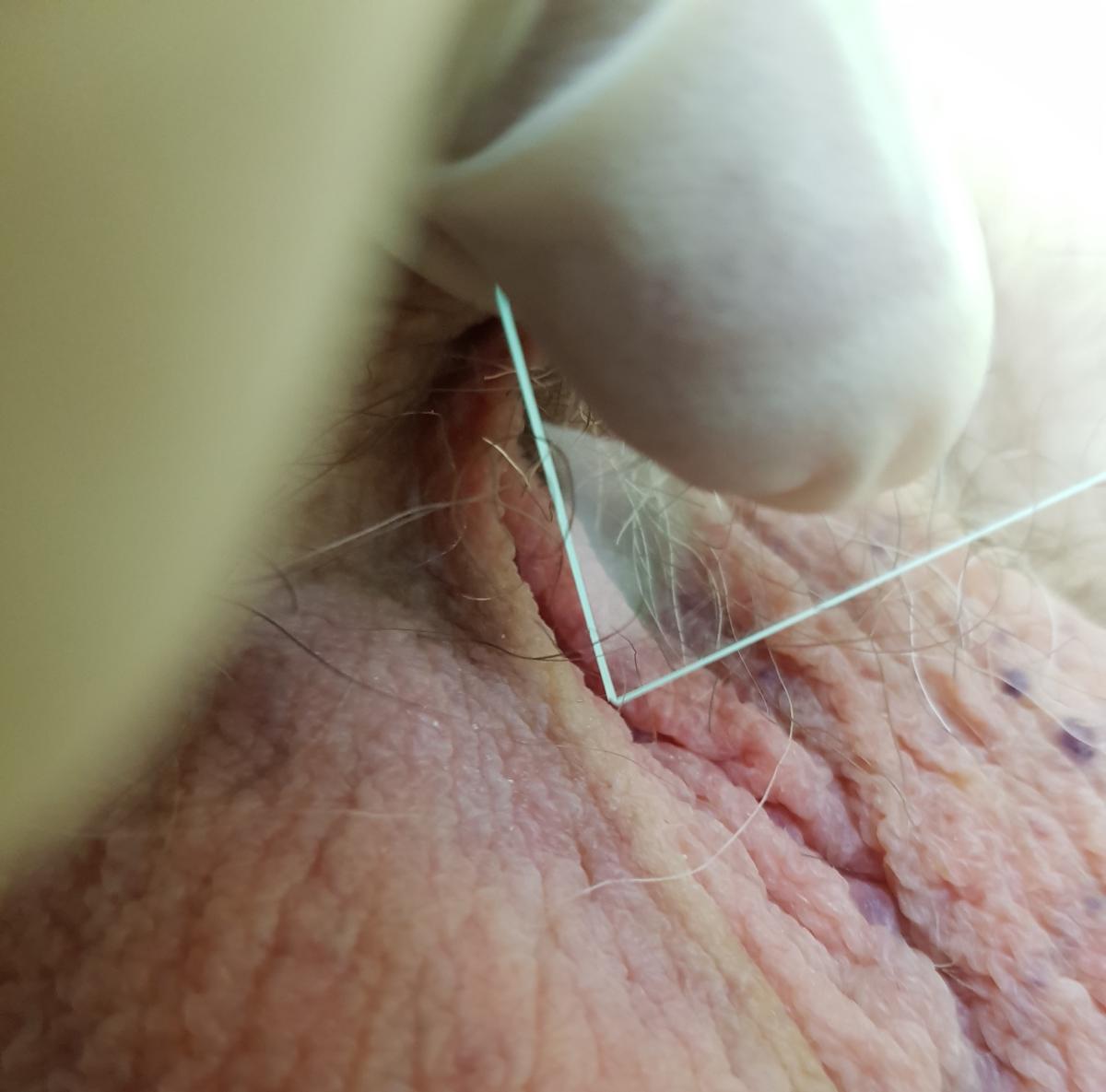 соскоб на грибок соскоб на грибок мошонки