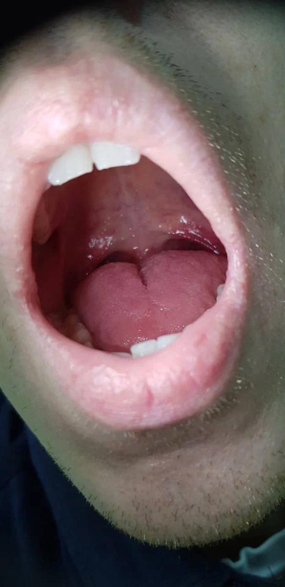 сосуды во рту сосуды во рту