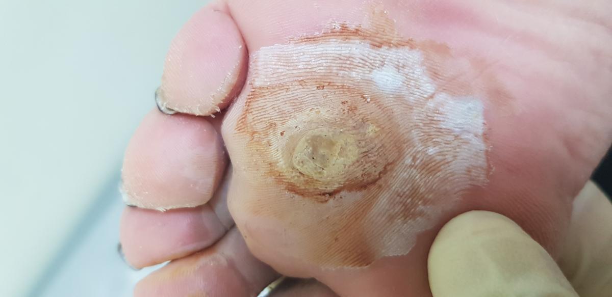 сразц после электрофореза