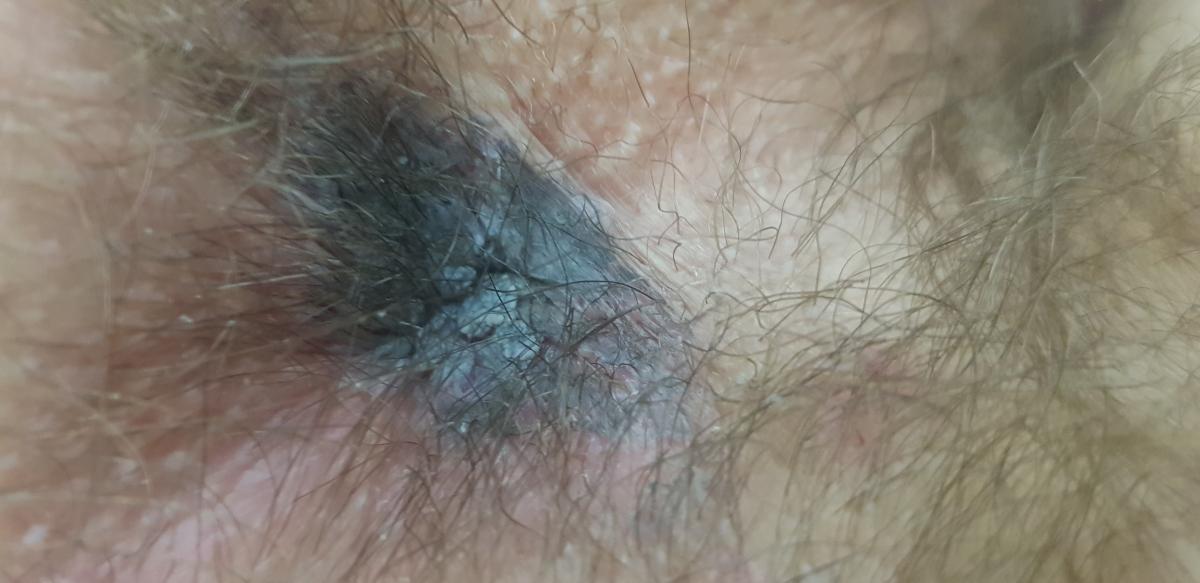 результат электрофореза