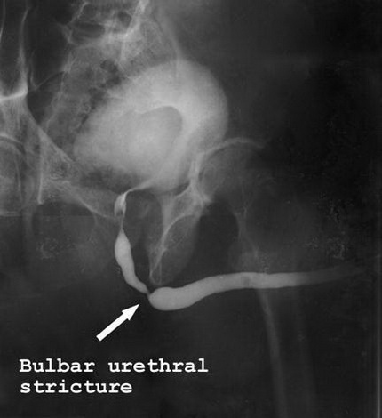 Стриктура уретры на рентгене