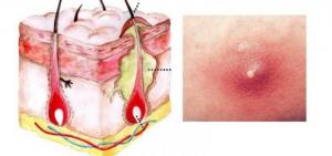 Лечение воспалительных процессов наружных половых органов | КЛРЦ