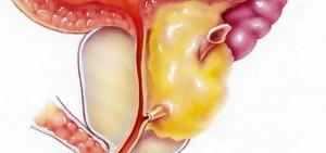 Диагностика абактериального простатита и лечение
