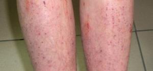Дерматит на ногах — фото с описанием симптомов, лечение, причины