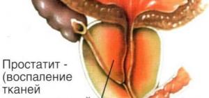 Эхографическая картина хронического простатита что это