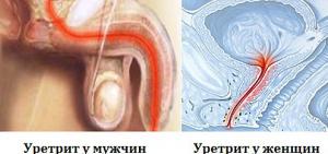 Простатит уретрит лечение антибиотиками