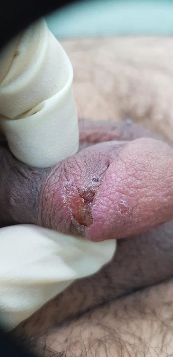 трещиновидный первичный шанкр