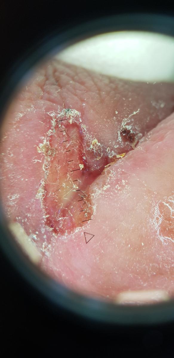 Твердый шанкр