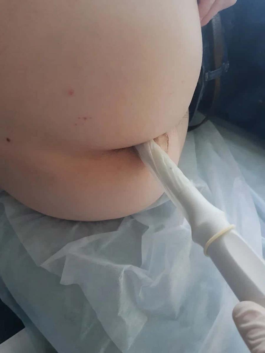 трансректальное УЗИ простаты