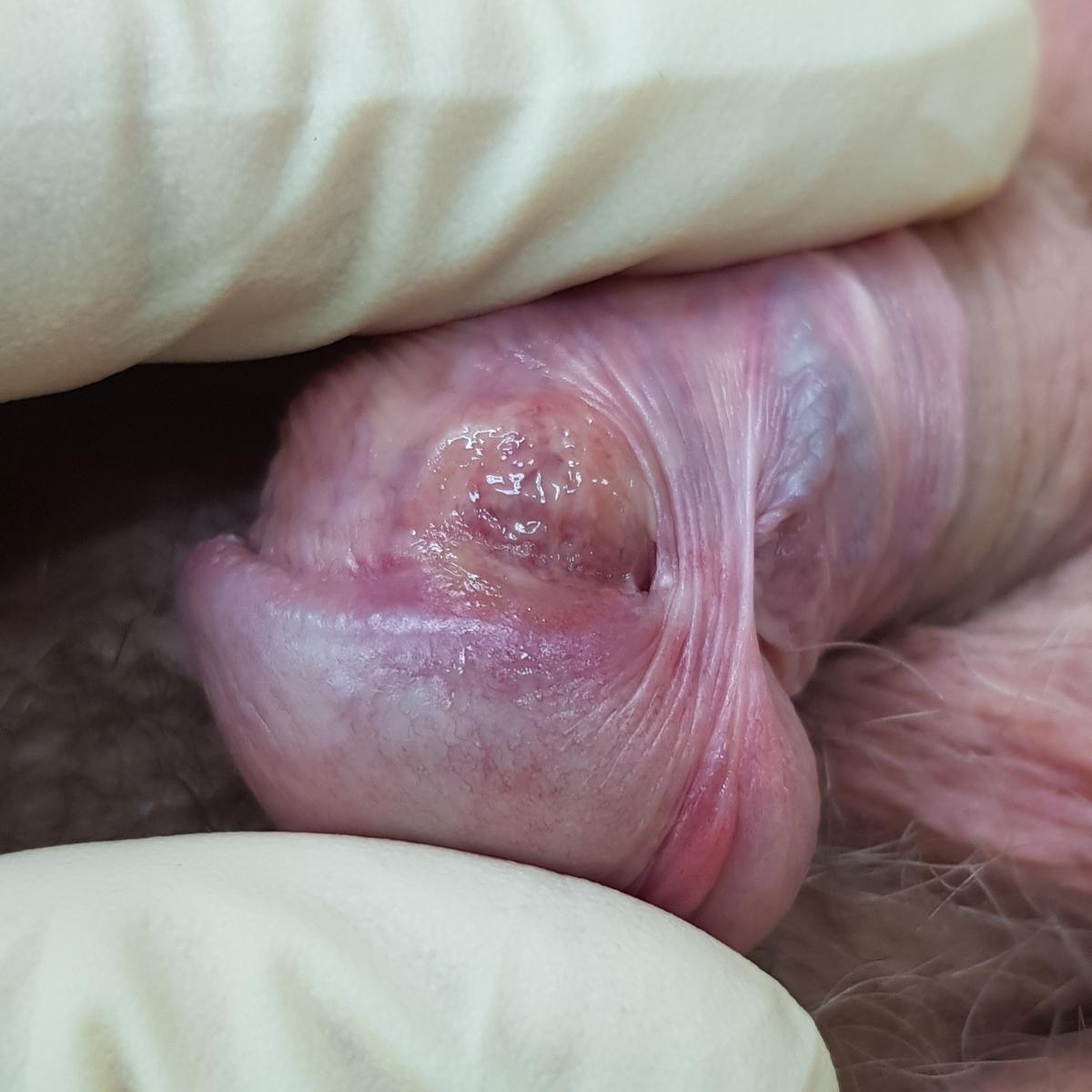 шанкры на члене прыщи на члене при сифилисе