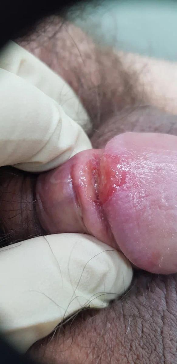 Вирус герпеса шанкр