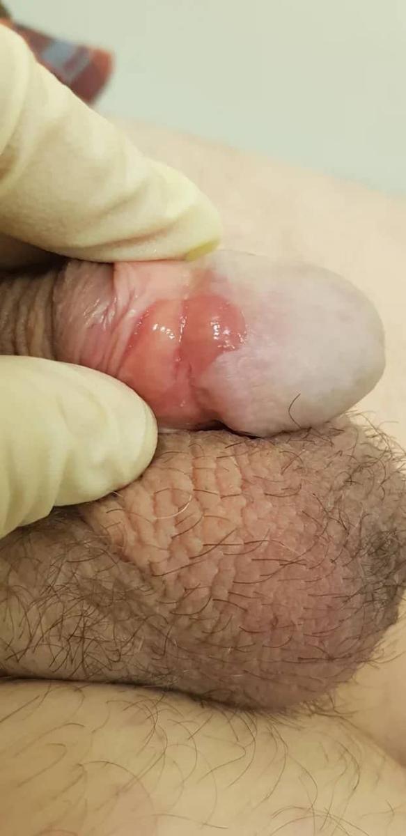 симптомы сифилиса на члене, шанкр