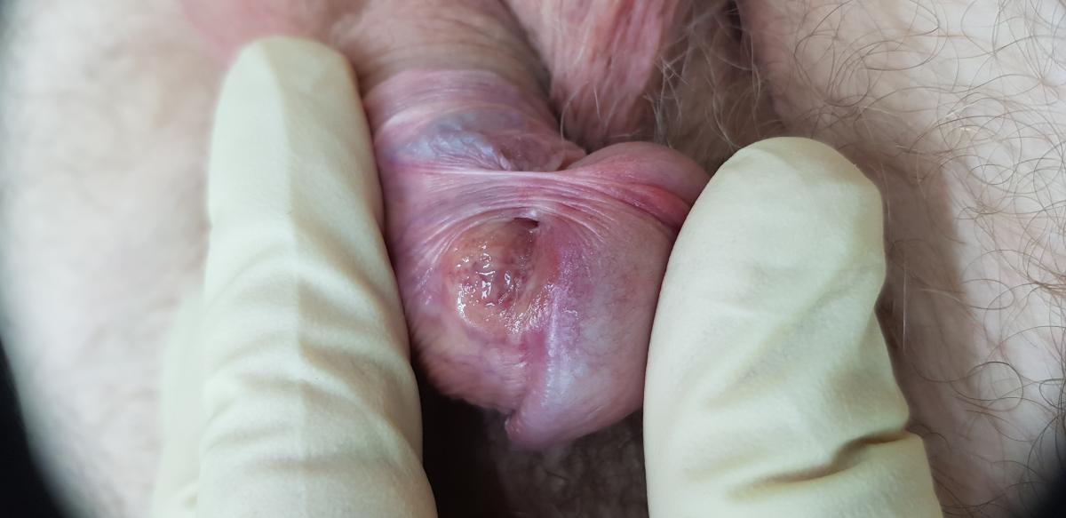 твердый шанкр -первичные признаки первичный сифилис