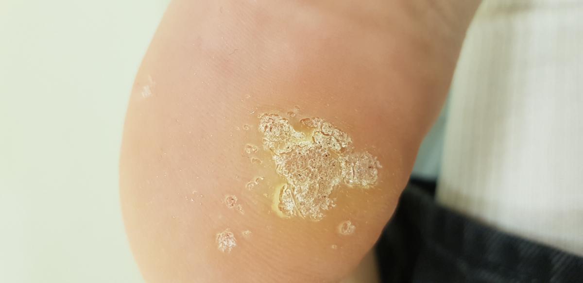 Лечение подошвенных бородавок