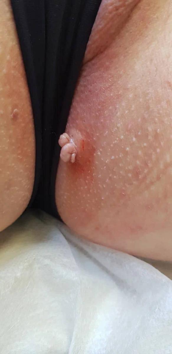 удаление большой фибропапилломы удаление большой фибропапилломы