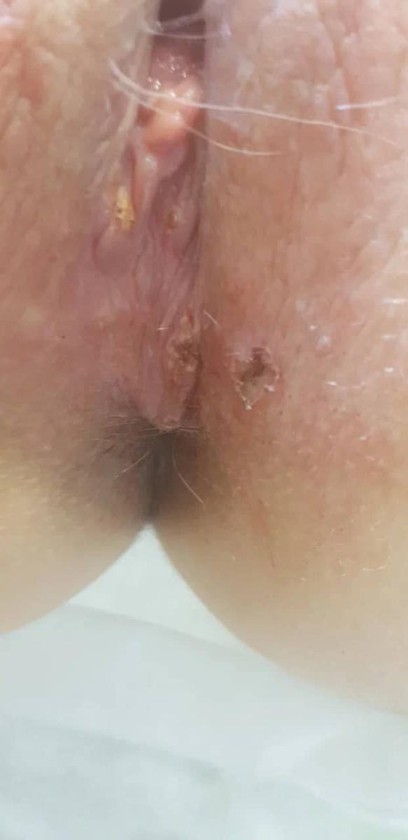 удаление кандилом удаление кандилом