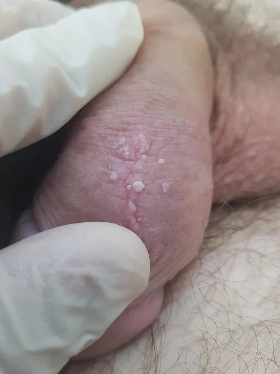 удаление кондилом удаление кондилом