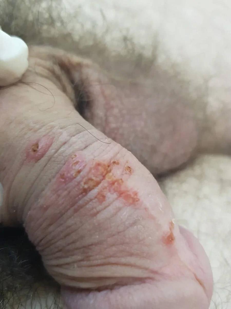 удаление кондилом удаление кондилом