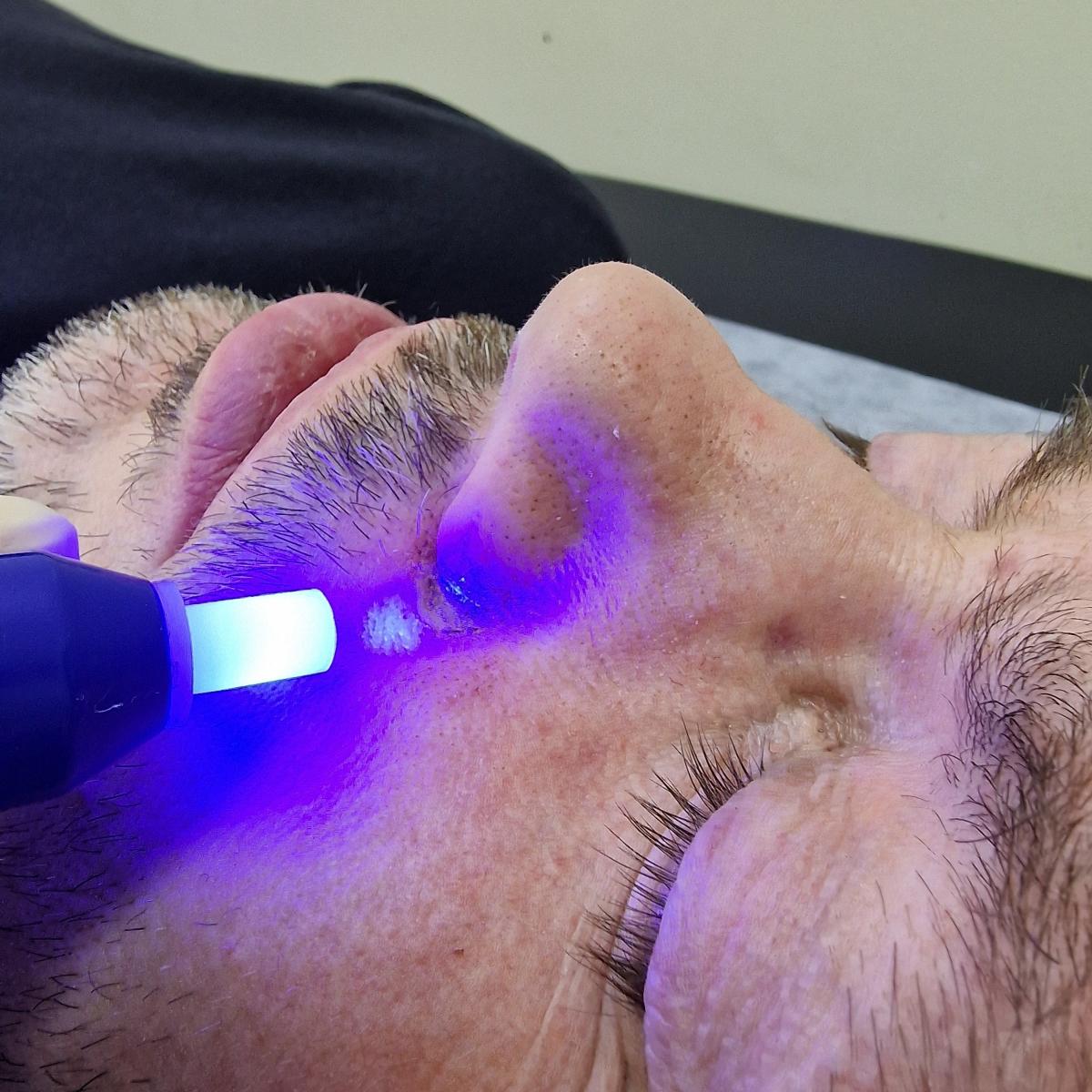 Удаление невуса на лице озотом Удаление невуса на лице