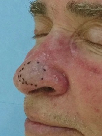 фото до удаления опухоли на носу