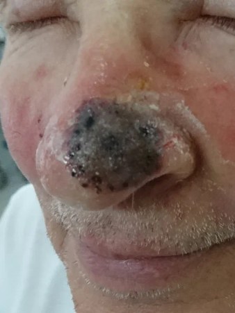 фото после удаления опухоли на носу