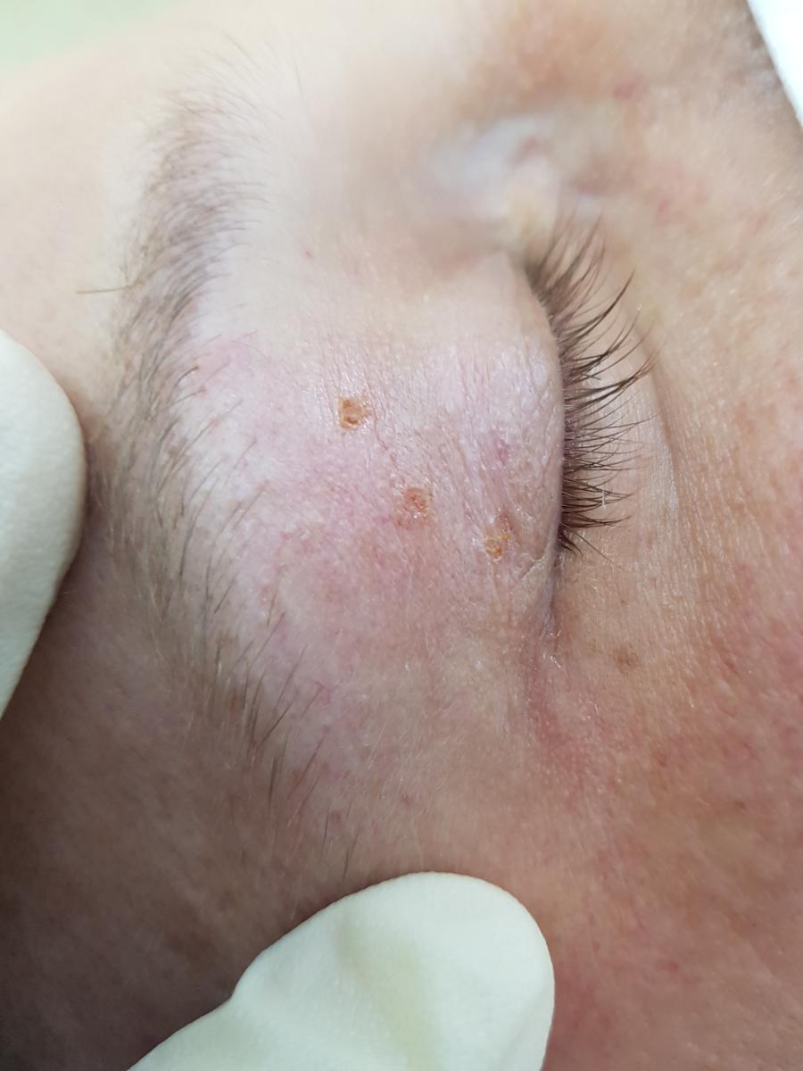 после удаления папиллом на веке удаление папиллом