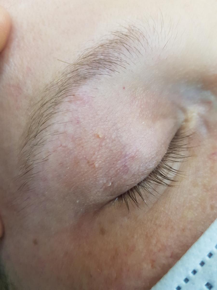 папилломы на верхнем веке папиломы на веке