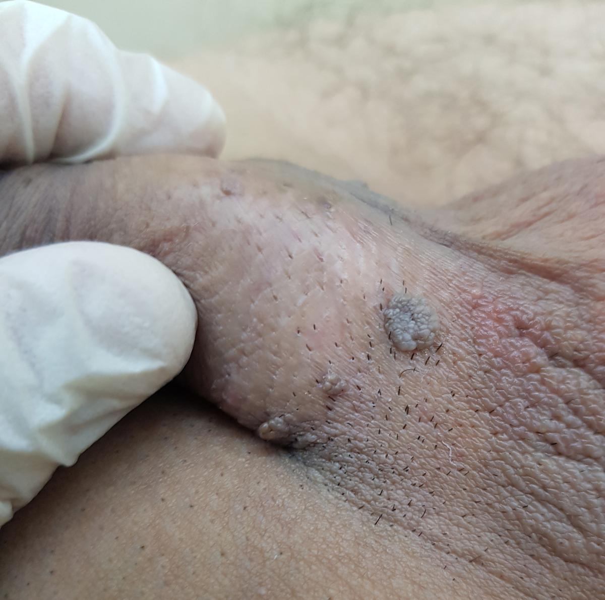 Пигментные папиломы