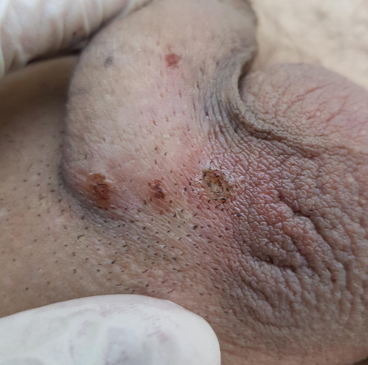 После удаления пигментных папилом